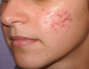 Crisderma - Dermato-venerologie si dermato-cosmetica